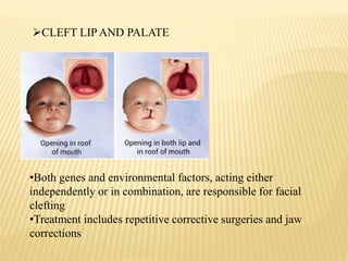 CLEFT LIP AND PALATE
•Both genes and environmental factors, acting either
independently or in combination, are responsible for facial
clefting
•Treatment includes repetitive corrective surgeries and jaw
corrections
 
