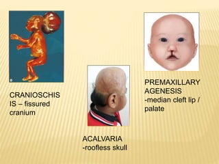 ACALVARIA
-roofless skull
CRANIOSCHIS
IS – fissured
cranium
PREMAXILLARY
AGENESIS
-median cleft lip /
palate
 
