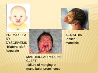 PREMAXILLA
RY
DYSGENESIS
-bilateral cleft
lip/palate
AGNATHIA
-absent
mandible
MANDIBULAR MIDLINE
CLEFT
-failure of merging of
mandibular prominence
 