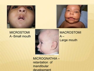 MICROSTOMI
A -Small mouth
MACROSTOMI
A –
Large mouth
MICROGNATHIA –
retardation of
mandibular
development
 