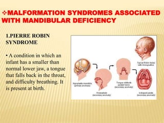 MALFORMATION SYNDROMES ASSOCIATED
WITH MANDIBULAR DEFICIENCY
1.PIERRE ROBIN
SYNDROME
• A condition in which an
infant has a smaller than
normal lower jaw, a tongue
that falls back in the throat,
and difficulty breathing. It
is present at birth.
 