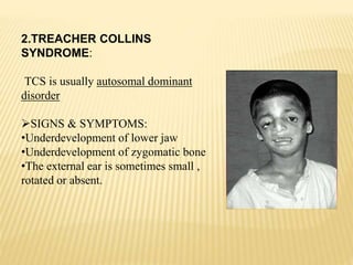 2.TREACHER COLLINS
SYNDROME:
TCS is usually autosomal dominant
disorder
SIGNS & SYMPTOMS:
•Underdevelopment of lower jaw
•Underdevelopment of zygomatic bone
•The external ear is sometimes small ,
rotated or absent.
 
