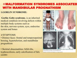 MALFORMATION SYNDROMES ASSOCIATED
WITH MANDIBULAR PROGNATHISM
1.GORLIN SYNDROME:
Gorlin–Goltz syndrome, is an inherited
medical condition involving defects within
multiple body systems such as
the skin, nervous system, eyes, endocrine
system and bones
SYMPTOMS
• Distinct faces: frontal and temporoparietal
bossing, hypertelorism, and mandibular
prognathism
• Skeletal abnormalities: bifid ribs,
kyphoscoliosis, early calcification of falx
cerebri
 