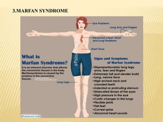 3.MARFAN SYNDROME
 
