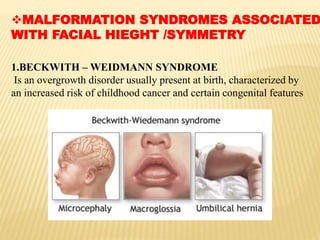 MALFORMATION SYNDROMES ASSOCIATED
WITH FACIAL HIEGHT /SYMMETRY
1.BECKWITH – WEIDMANN SYNDROME
Is an overgrowth disorder usually present at birth, characterized by
an increased risk of childhood cancer and certain congenital features
 