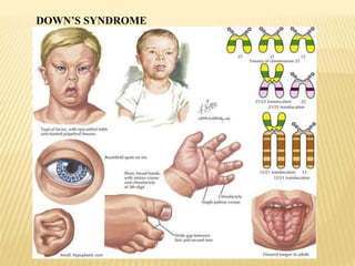 DOWN’S SYNDROME
 