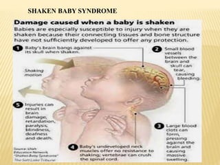 SHAKEN BABY SYNDROME
 