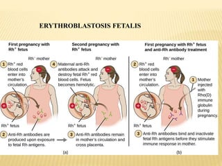 ERYTHROBLASTOSIS FETALIS
 