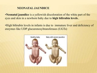 NEONATAL JAUNDICE
•Neonatal jaundice is a yellowish discoloration of the white part of the
eyes and skin in a newborn baby due to high bilirubin levels..
•High bilirubin levels in infants is due to immature liver and deficiency of
enzymes like UDP glucuronosyltransferases (UGTs)
 