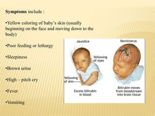 Symptoms include :
•Yellow coloring of baby’s skin (usually
beginning on the face and moving down to the
body)
•Poor feeding or lethargy
•Sleepiness
•Brown urine
•High – pitch cry
•Fever
•Vomiting
 