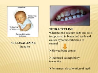 SULFASALAZINE
jaundice
TETRACYCLINE
•Chelates the calcium salts and so is
incoporated in bones and teeth and
causes hypomineralization of
enamel
Slowed bone growth
Increased susceptibility
to cavities
Permanent discoloration of teeth
 