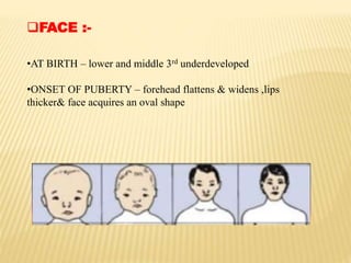 FACE :-
•AT BIRTH – lower and middle 3rd underdeveloped
•ONSET OF PUBERTY – forehead flattens & widens ,lips
thicker& face acquires an oval shape
 
