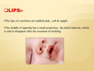 LIPS:-
The lips of a newborn are reddish pink , soft & supple
The middle of upperlip has a small projection , the labial tubercle, which
is said to disappear after the sessation of suckling.
 