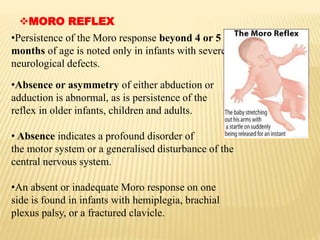 MORO REFLEX
•Persistence of the Moro response beyond 4 or 5
months of age is noted only in infants with severe
neurological defects.
•Absence or asymmetry of either abduction or
adduction is abnormal, as is persistence of the
reflex in older infants, children and adults.
• Absence indicates a profound disorder of
the motor system or a generalised disturbance of the
central nervous system.
•An absent or inadequate Moro response on one
side is found in infants with hemiplegia, brachial
plexus palsy, or a fractured clavicle.
 