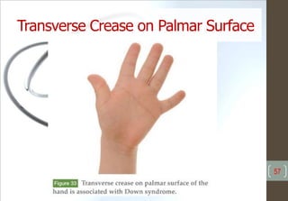 Transverse Crease on Palmar Surface
57
 