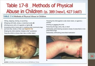 Table 17-8 Methods of Physical
Abuse in Children (p. 389 [new], 427 [old])
64
 