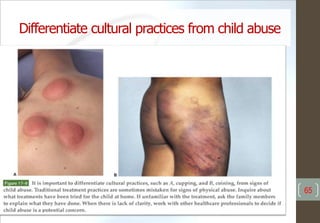 Differentiate cultural practices from child abuse
65
 