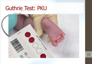 Guthrie Test: PKU
100
 