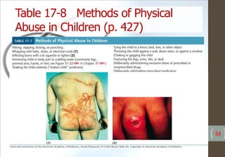 Table 17-8 Methods of Physical
Abuse in Children (p. 427)
64
 