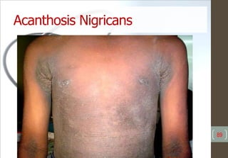 Acanthosis Nigricans
89
 
