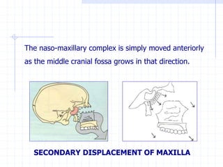 The naso-maxillary complex is simply moved anteriorly
as the middle cranial fossa grows in that direction.
SECONDARY DISPLACEMENT OF MAXILLA
 