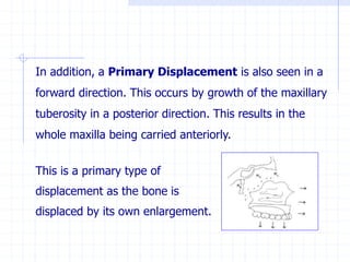 In addition, a Primary Displacement is also seen in a
forward direction. This occurs by growth of the maxillary
tuberosity in a posterior direction. This results in the
whole maxilla being carried anteriorly.
This is a primary type of
displacement as the bone is
displaced by its own enlargement.
 