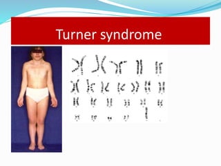Turner syndrome
 