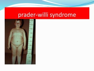 prader-willi syndrome
 