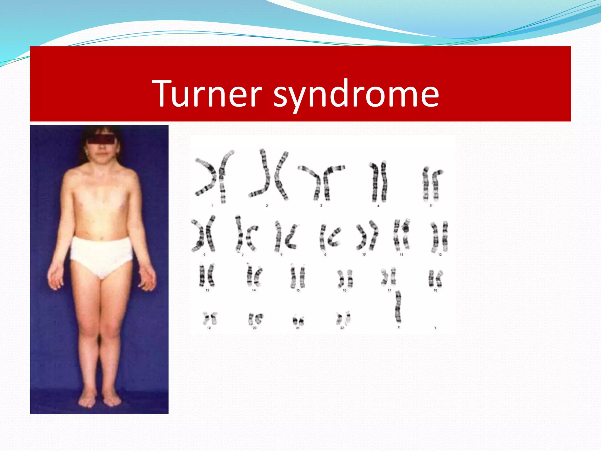 Turner syndrome 
 