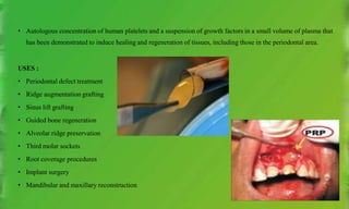 • Autologous concentration of human platelets and a suspension of growth factors in a small volume of plasma that
has been demonstrated to induce healing and regeneration of tissues, including those in the periodontal area.
USES :
• Periodontal defect treatment
• Ridge augmentation grafting
• Sinus lift grafting
• Guided bone regeneration
• Alveolar ridge preservation
• Third molar sockets
• Root coverage procedures
• Implant surgery
• Mandibular and maxillary reconstruction
 