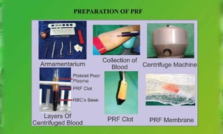 PREPARATION OF PRF
 