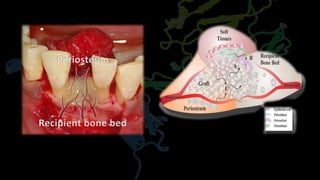 Recipient bone bed
Periosteum
 