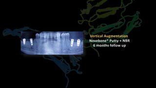 Vertical Augmentation
Novebone® Putty + NBR
6 months follow up
 