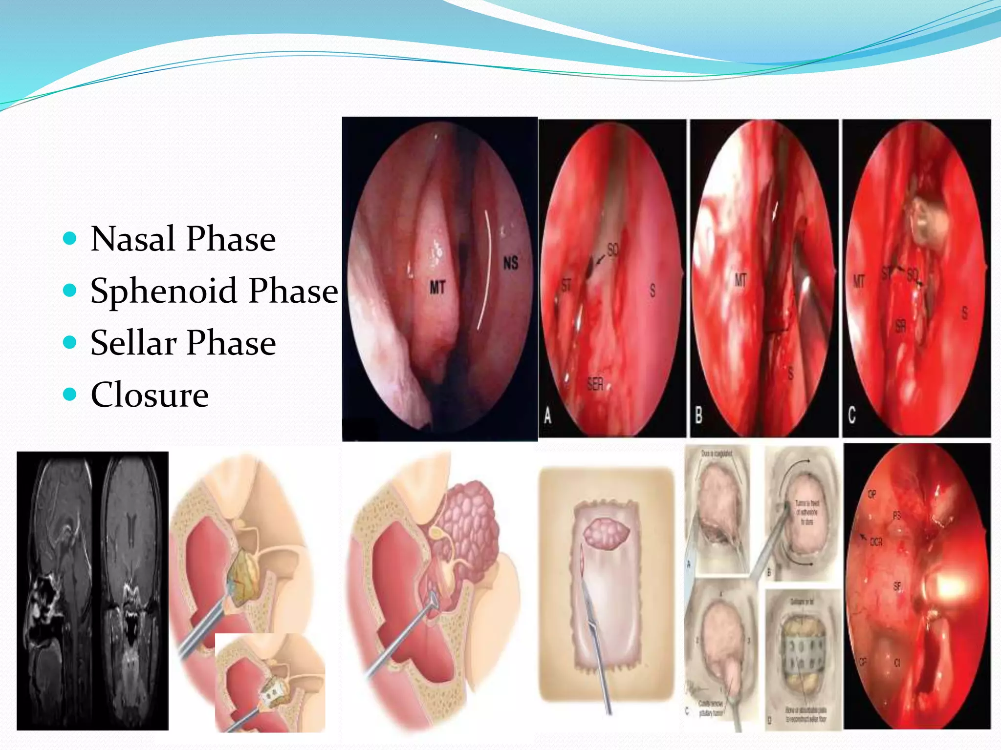  Nasal Phase
 Sphenoid Phase
 Sellar Phase
 Closure
 