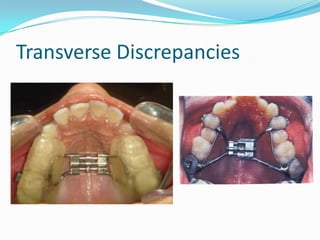 Transverse Discrepancies
 