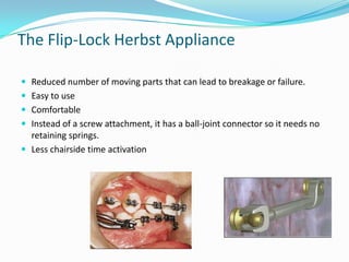 The Flip-Lock Herbst Appliance

 Reduced number of moving parts that can lead to breakage or failure.
 Easy to use
 Comfortable
 Instead of a screw attachment, it has a ball-joint connector so it needs no
  retaining springs.
 Less chairside time activation
 