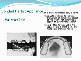 Bonded Herbst Appliance It is a wire reinfofced acrylic splint.
                                  The pivots are fixed to the wire
                                    framework at distobuucal aspect
  High Angle Cases                  of the upper first molar mesial
                                    aspect of lower first premolar.
                                  Tube is fitted to the pivot in the
                                     upper molars & shaft is fixed to
                                     mandibular premolar region
 