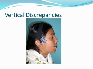 Vertical Discrepancies
 