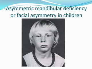 Asymmetric mandibular deficiency
  or facial asymmetry in children
 