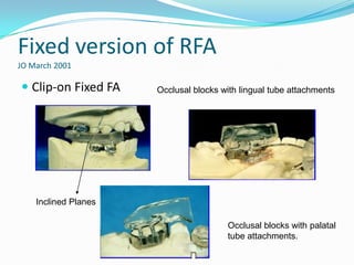 Fixed version of RFA
JO March 2001

 Clip-on Fixed FA    Occlusal blocks with lingual tube attachments




    Inclined Planes

                                       Occlusal blocks with palatal
                                       tube attachments.
 