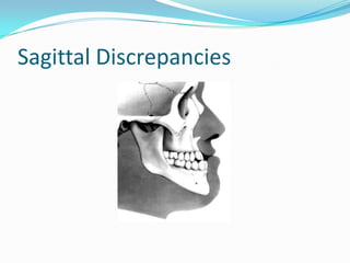 Sagittal Discrepancies
 