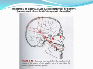 CORRECTION OF SKELETAL CLASS II AND REDIRECTION OF GROWTH
    ;(excess growth of maxilla/deficient growth of mandible)
 