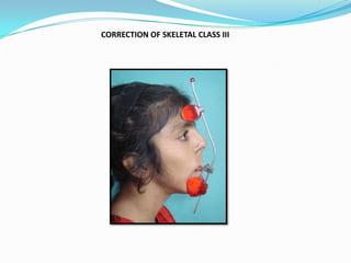 CORRECTION OF SKELETAL CLASS III
 
