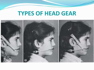 TYPES OF HEAD GEAR
 