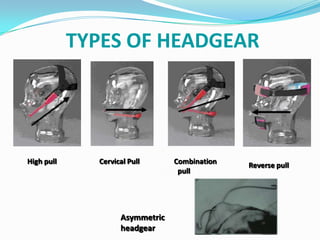 TYPES OF HEADGEAR




High pull     Cervical Pull      Combination   Reverse pull
                                  pull




                    Asymmetric
                    headgear
 