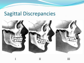 Sagittal Discrepancies
 