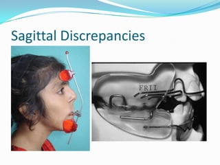 Sagittal Discrepancies
 