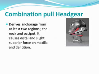 Combination pull Headgear
 Derives anchorage from
  at least two regions ; the
  neck and occiput. It
  causes distal and slight
  superior force on maxilla
  and dentition.
 