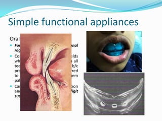 Simple functional appliances
Oral screens
 Forerunner      of     functional
  regulator
 Consists of vestibular shields
  which holds the lip away from all
  teeth except upper incisors b/c
  pressure from lips is transferred
  to U I and acts to move them
  palatally
 Can be used in mixed dentition
  and aids patient with digit
  sucking
 