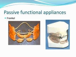 Passive functional appliances
 Frankel
 